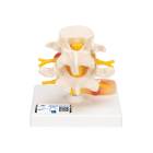 3B Scientific A76 Lumbar Vertebrae Teaching Model - 3B Smart Anatomy