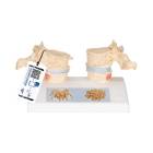 3B Scientific A95 Osteoporosis Model - 3B Smart Anatomy