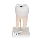 Lower Twin-Root Molar Showing Cavities 2-Part