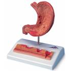 Stomach Model with Ulcers