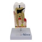 Nasco MG22727 Dental Disease Model, 10x Enlarged - Front View