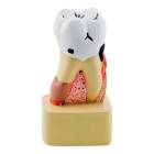 Nasco MG22728 Dental Disease Model, 4x Enlarged - Front View