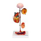 Nasco MG22747 Effects of Arterial Hypertension Pathology Model, 5-Part