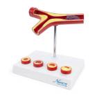 Nasco MG29729 Arteriosclerosis and Thrombosis with Artery Cross-Section Model