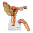 Nasco MG29947 Female Genital Organ with Pathology Model, 2 Parts - Front View