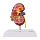Nasco MG31019 Kidney with Pathology Model, 2.5x Enlarged