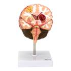 Nasco MG31100 Brain Section with Pathology Model - Angle 1