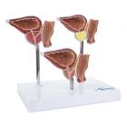 Nasco MG31153 Normal and Pathological Prostate Model, 3 Parts - Front View