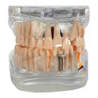 Nasco MG38398 Translucent Adult Dentition Normal and Pathology Model - Fron View