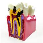 Nasco MG39442 Dental Disease Model, 6x Enlarged - Left Angle with Disease
