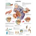 Arthritis Chart