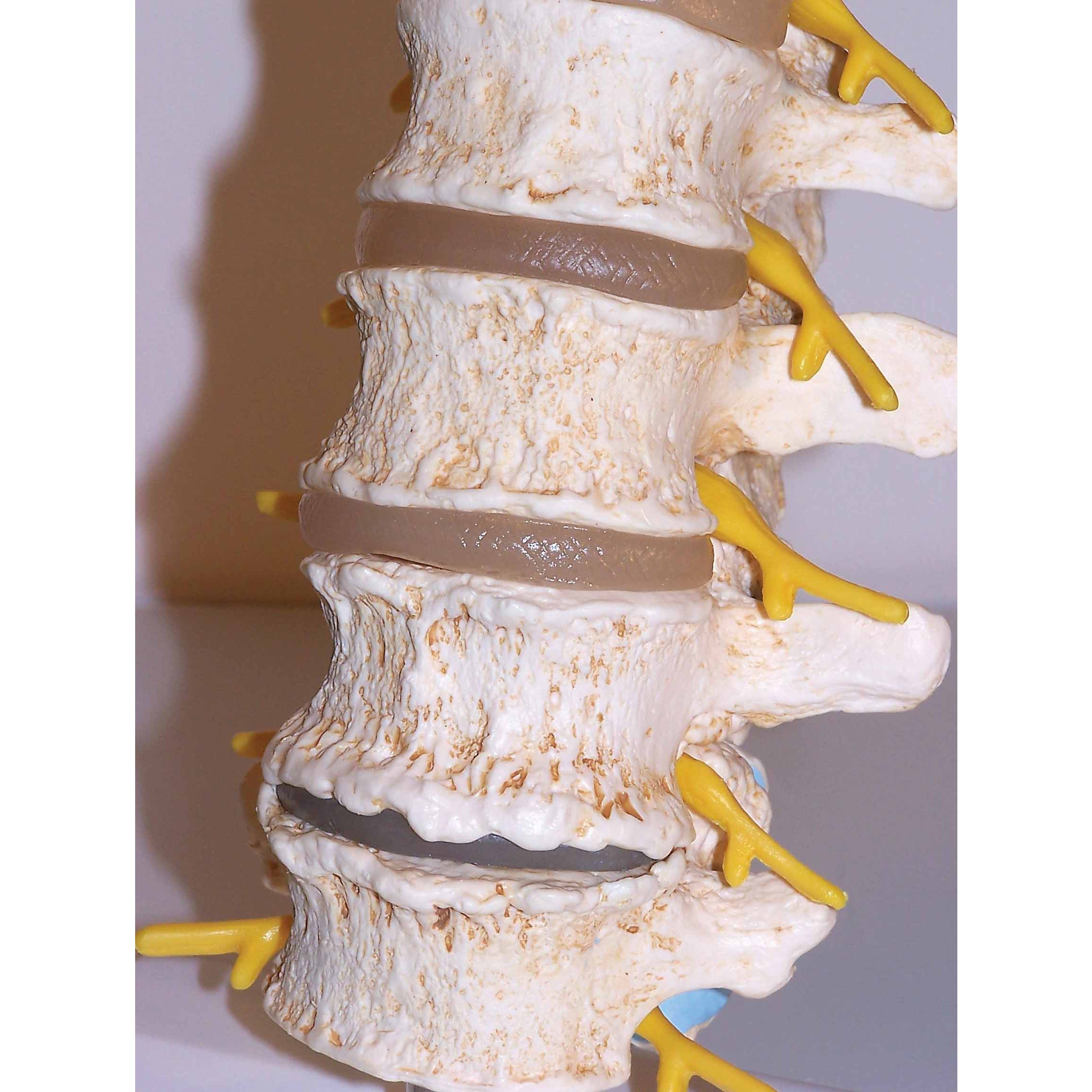 3B Scientific A795 Disc Prolapse and Vertebral Degeneration Stages
